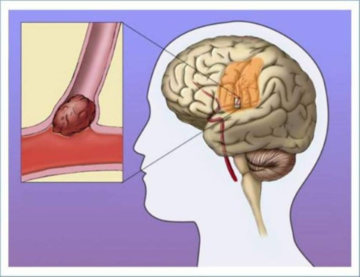 ¿Cínico, agresivo, hostil? Gran candidato a infarto cerebral?