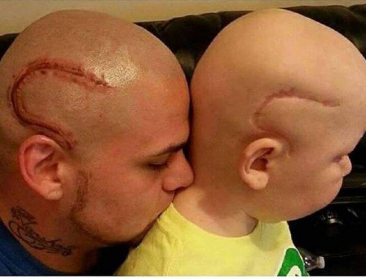 Un padre se tatúa la cicatriz de su hijo, operado de cáncer