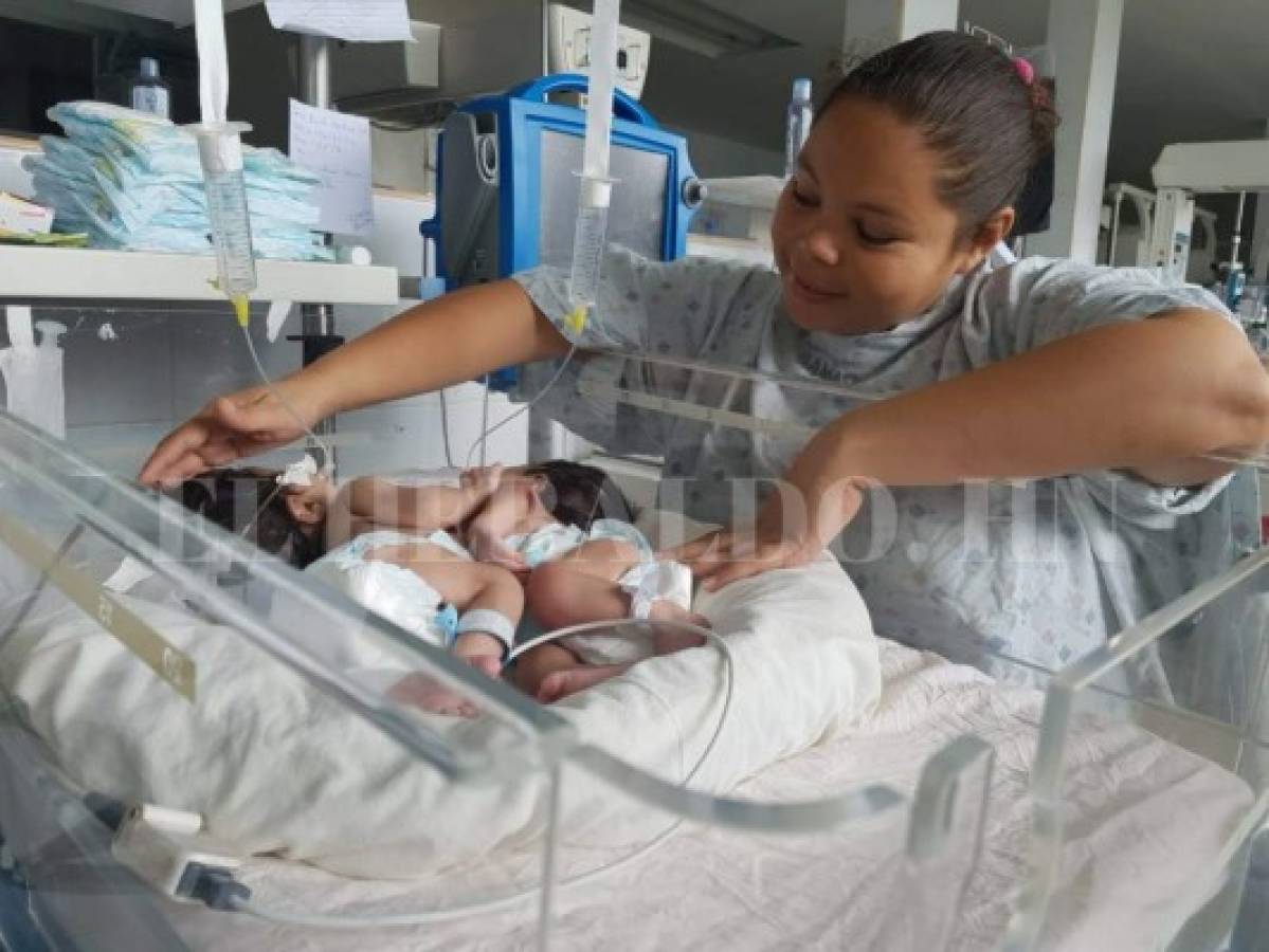 Hospital Materno Infantil: Mueren siamesas que compartían el mismo corazón e hígado