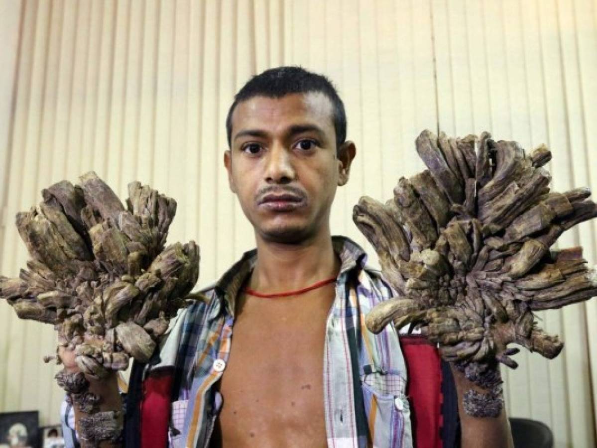 El 'hombre-árbol' bangladesí pide ser amputado