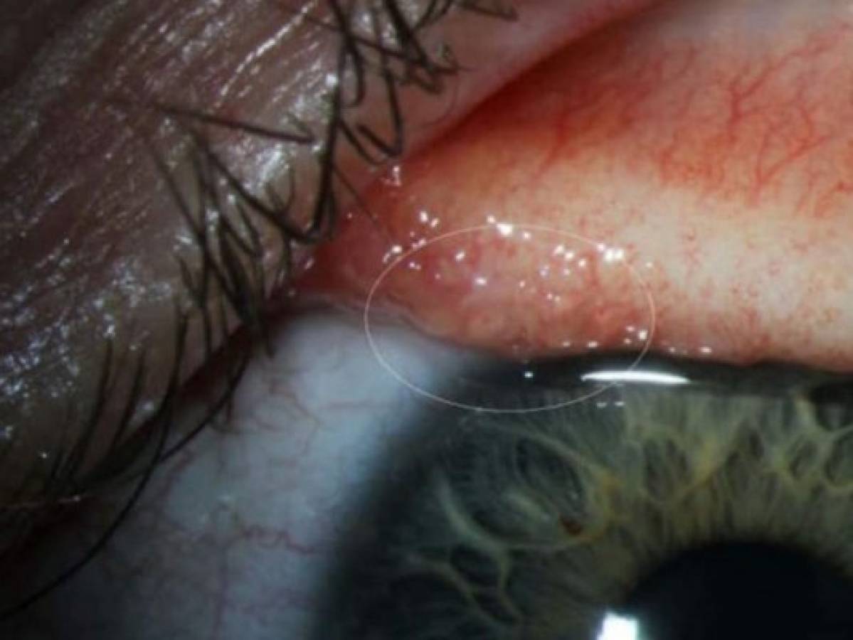 Retiran 14 gusanos de ojo de mujer en Oregon