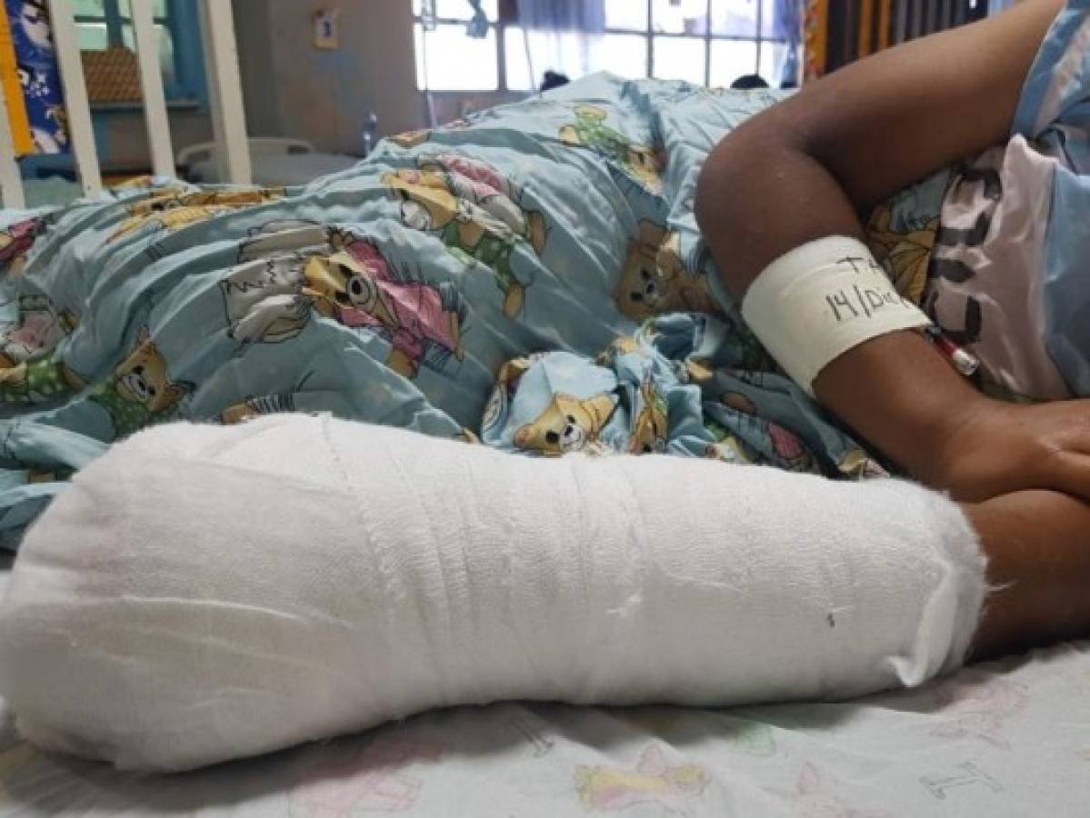 Por explosión de un mortero menor de La Paz pierde dos dedos