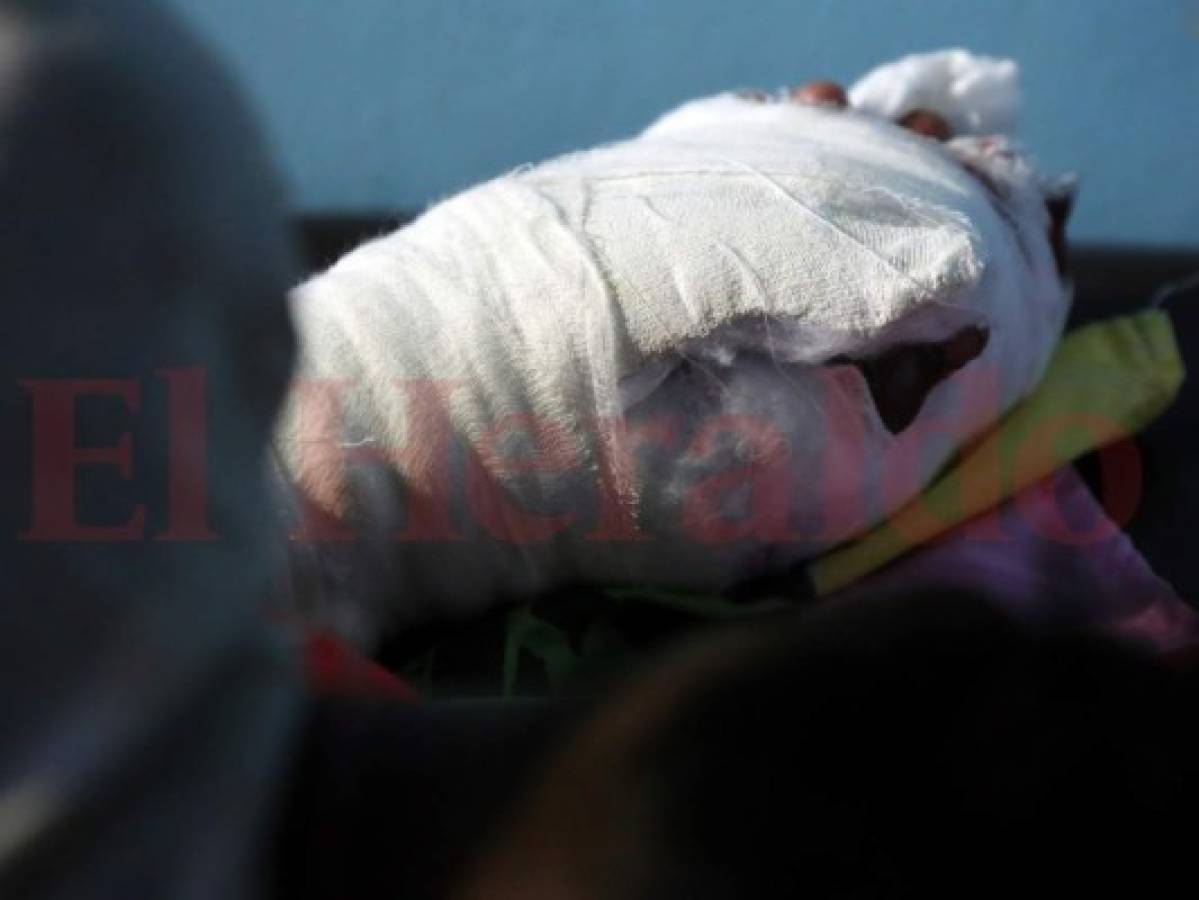 Tegucigalpa: Hombre pierde la mitad de su dedo tras reventarle un mortero