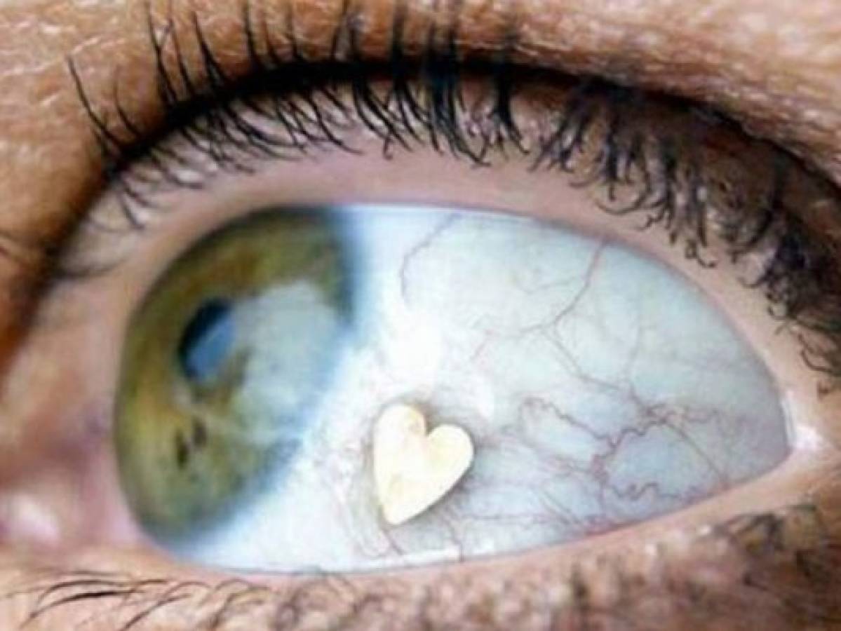 Joyas oculares, los peligrosos implantes que son tendencia entre los jóvenes