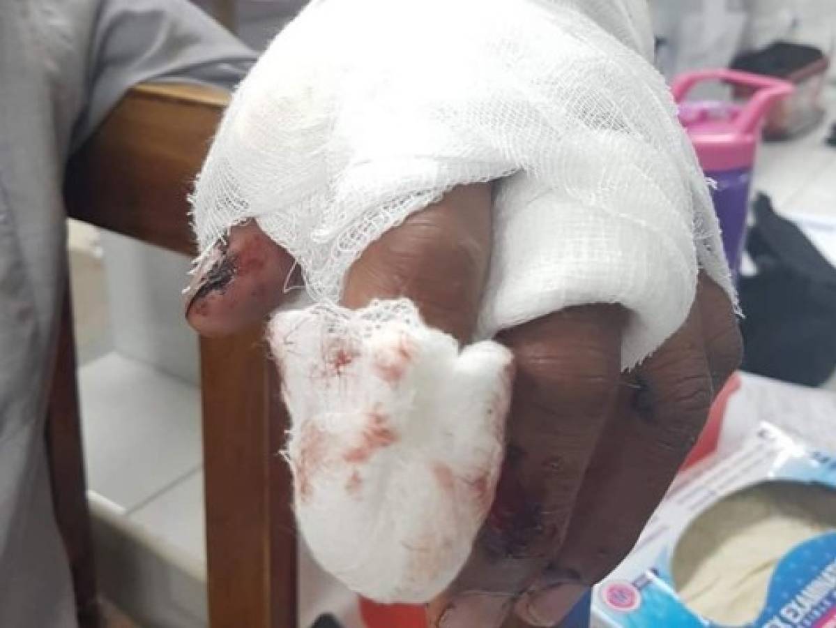 Cinco personas quemadas ingresaron al Hospital Escuela la noche del 31 de diciembre de 2018