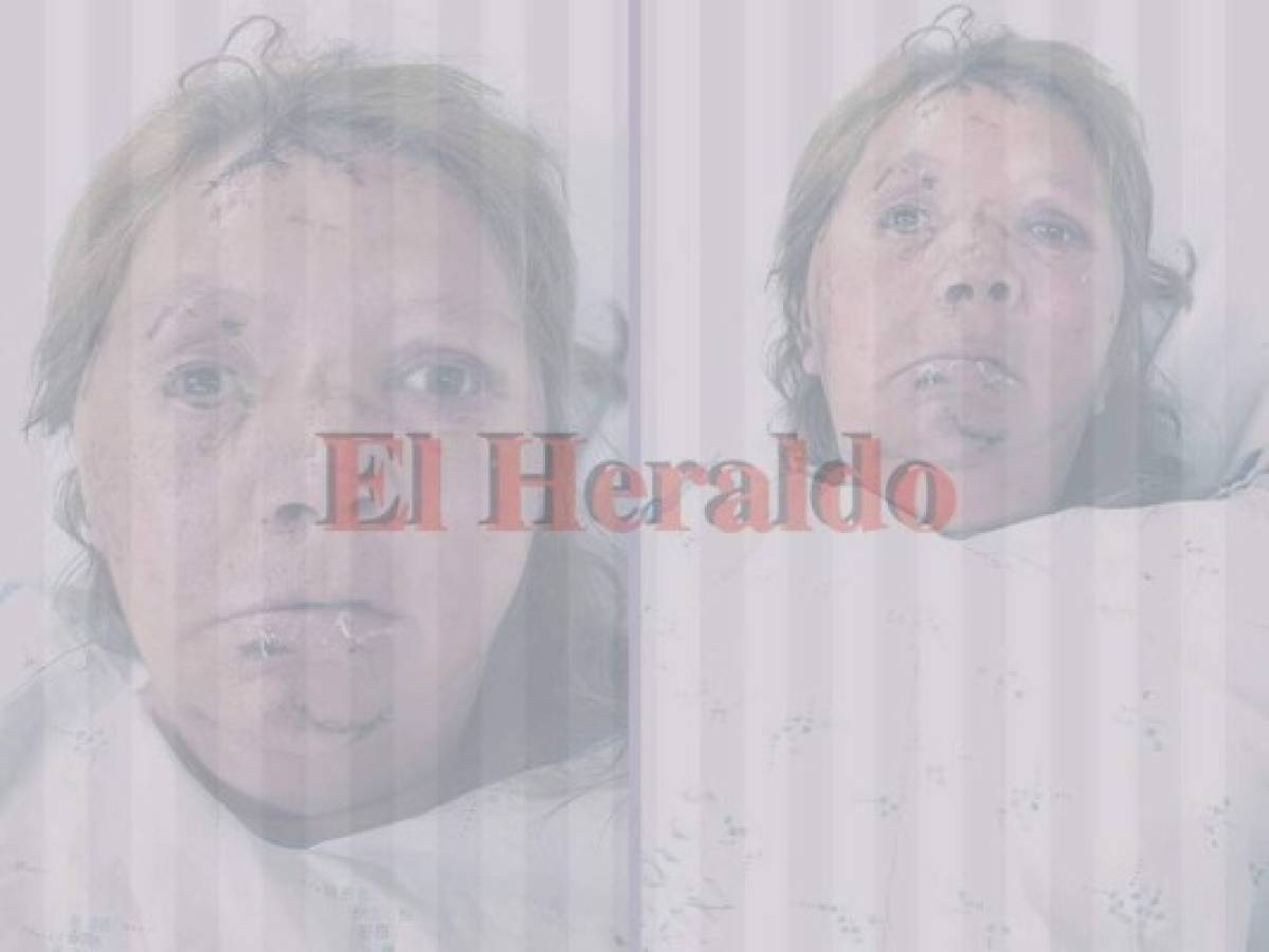 Hondureña fue atacada por su amiga por cobrarle una deuda de 6 mil lempiras