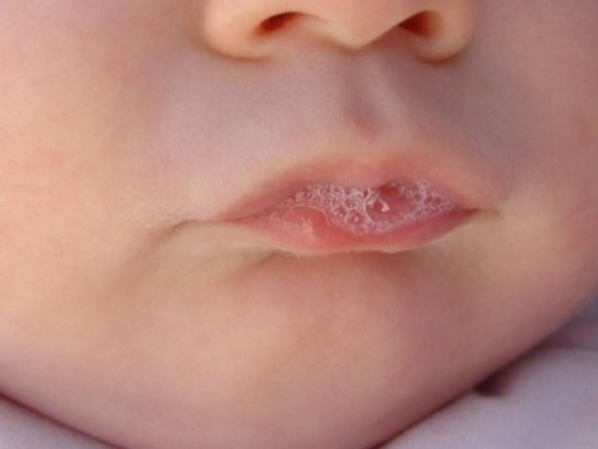 Síntomas y causas del tialismo, la producción excesiva de saliva