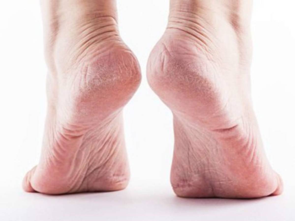 Despídete de los callos y durezas en los pies con un potente remedio casero