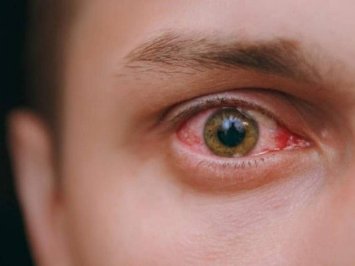 La conjuntivitis es una de las enfermedades que se puede evitar su contagio siempre y cuando se mantenga alejada de la persona que lo está padeciendo.