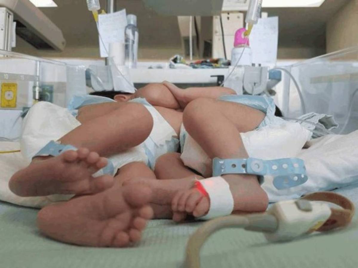 Hospital Materno Infantil: Mueren siamesas que compartían el mismo corazón e hígado