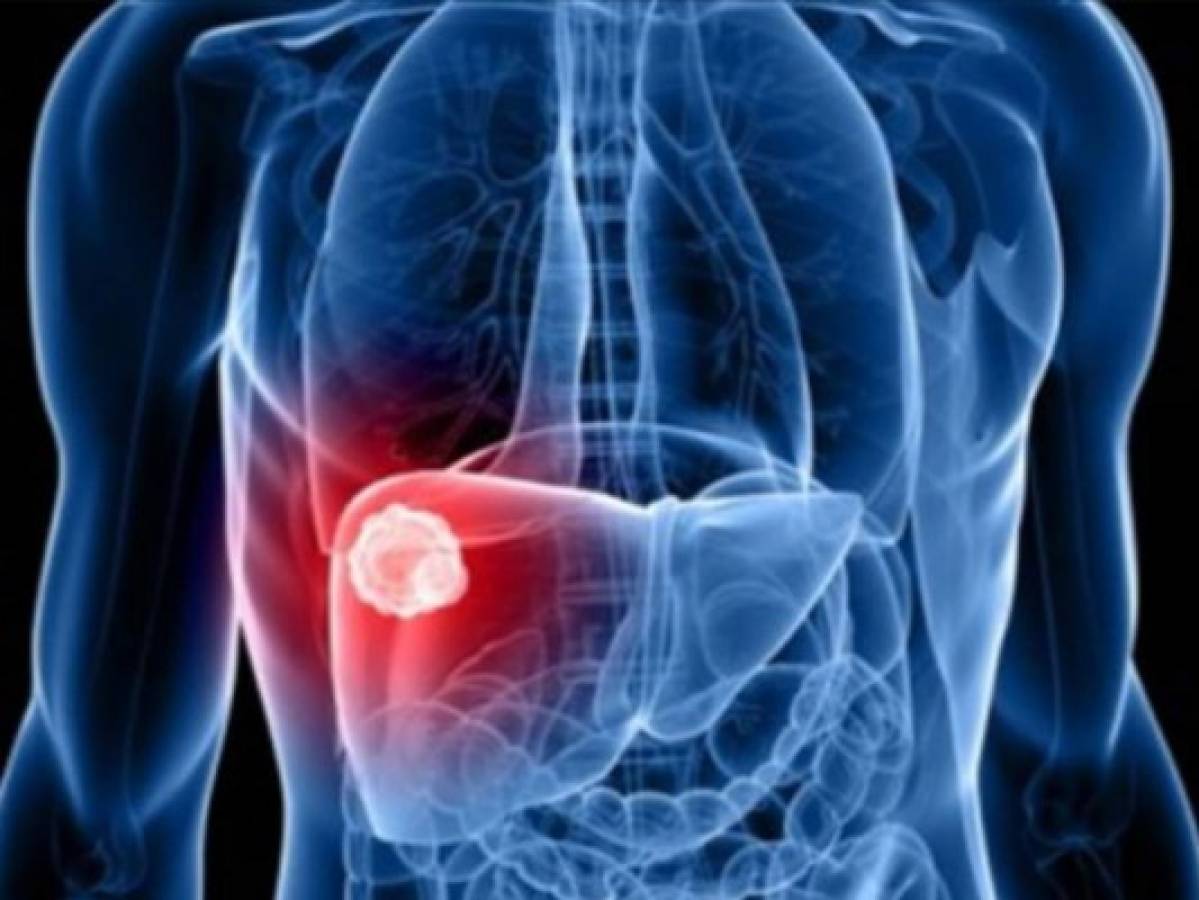 Seis síntomas que podrían indicarte cáncer de hígado  