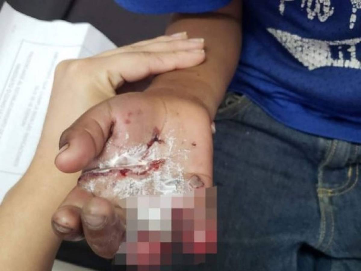 Menor pierde dos dedos al sufrir quemaduras por pólvora en La Paz
