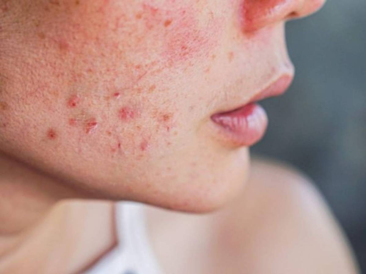 Colocar una mascarilla en la parte afectada de acné reduce su aspecto y previene su aparición. Foto: Pixabay