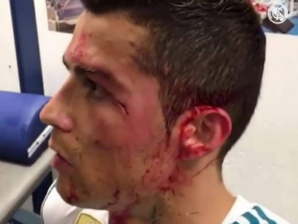 Real Madrid publica video de la herida en el rostro de Cristiano Ronaldo