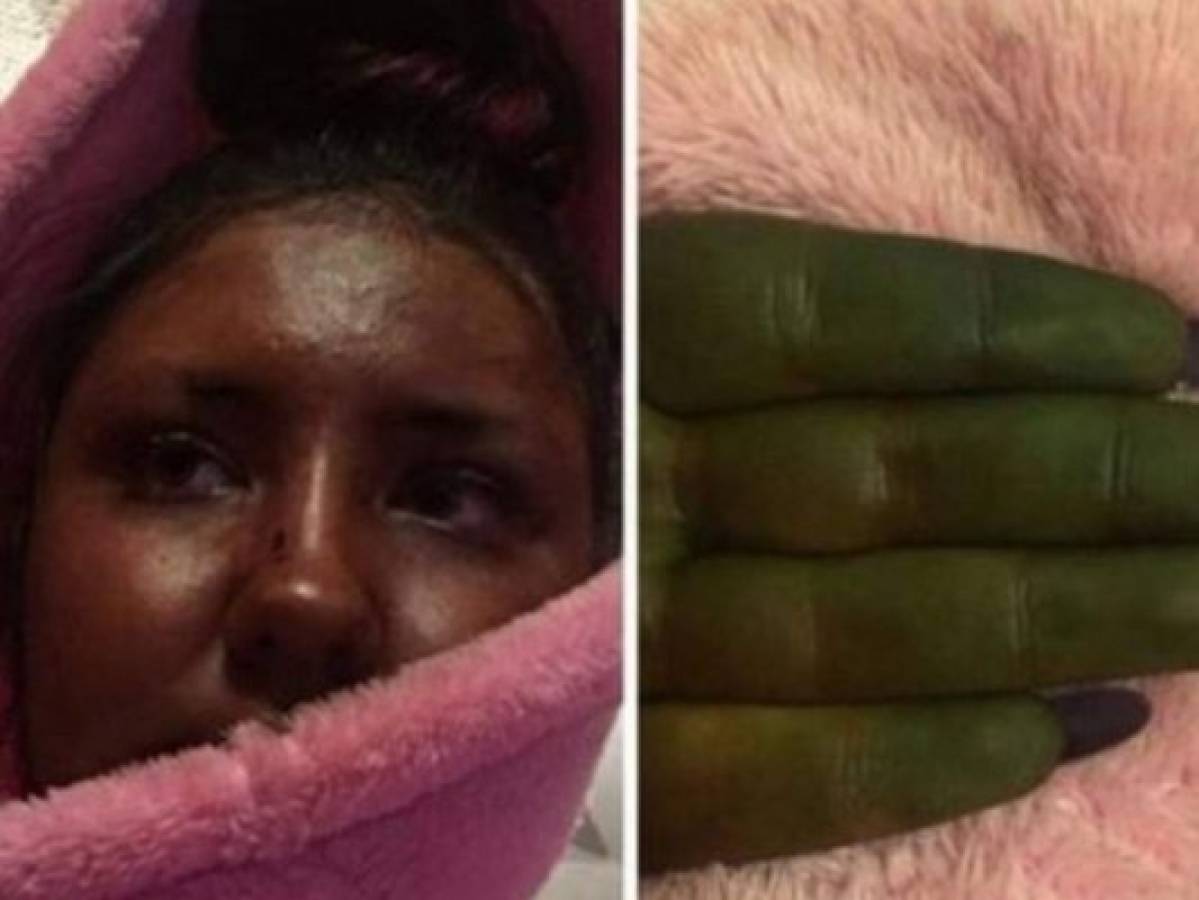 Se vuelve viral al quedar verde como Fiona o Hulk por un bronceado