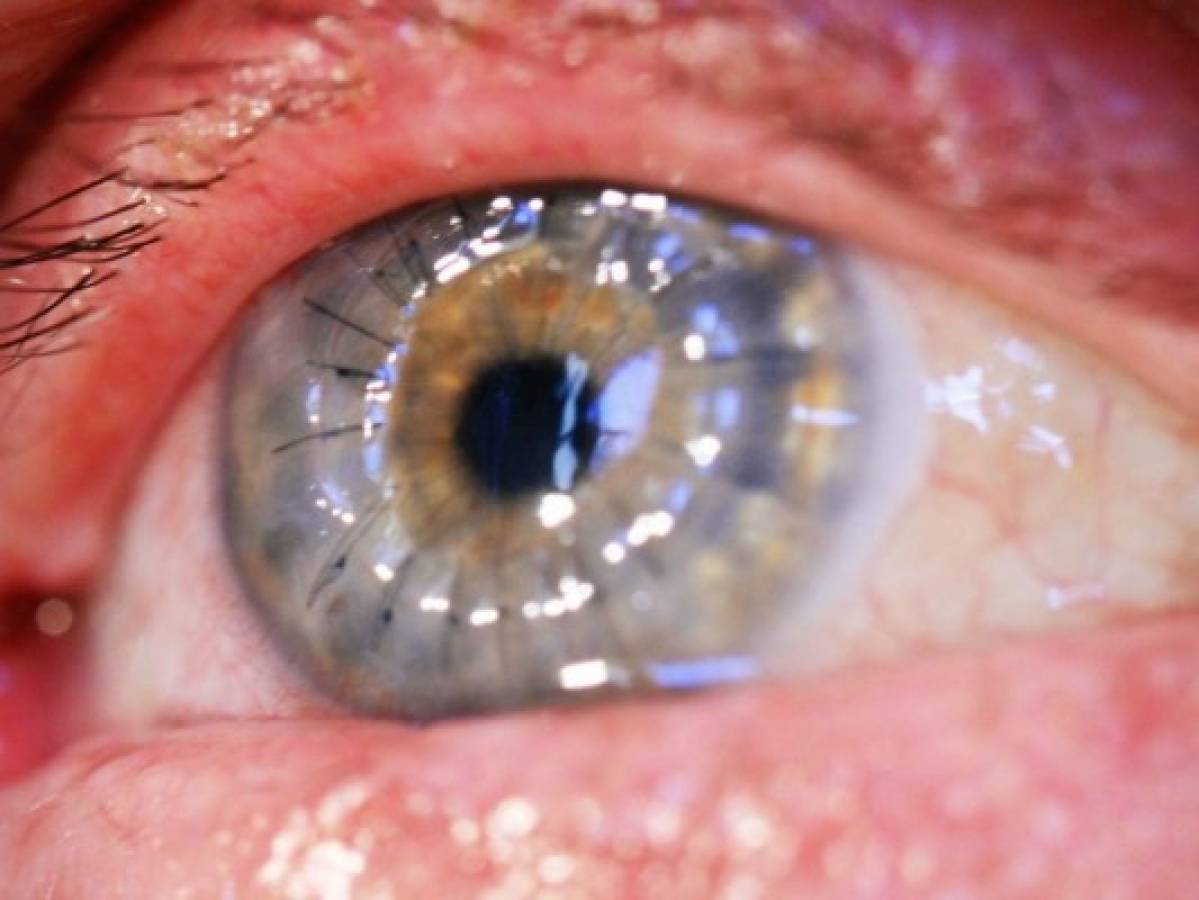 Médicos encuentran 27 lentes de contacto en ojo de una mujer