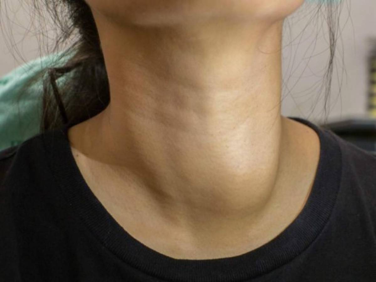 Cinco señales que indican que algo anda mal con su tiroides
