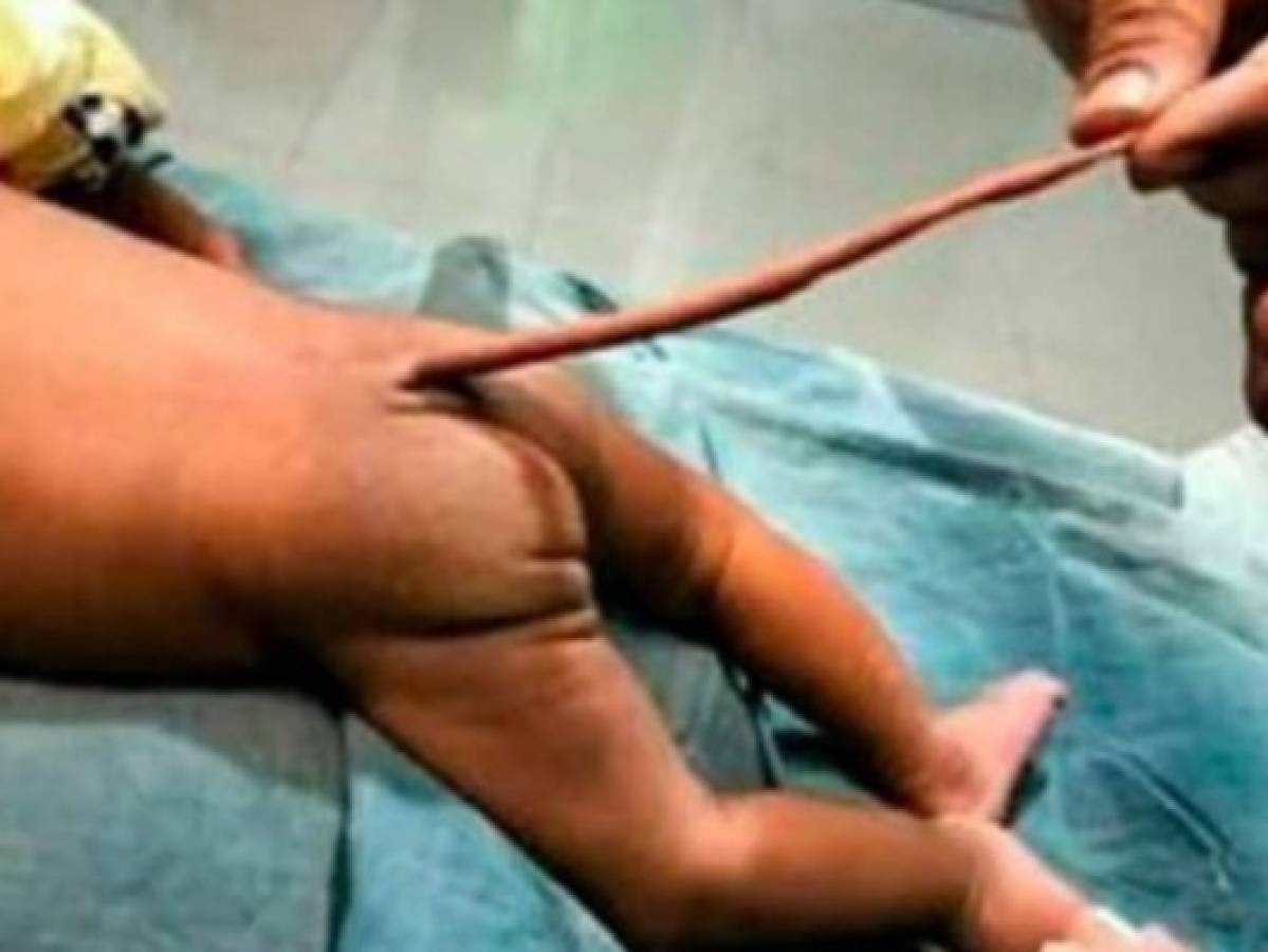 El extraño caso del bebé que nació con 'cola de rata' en Colombia