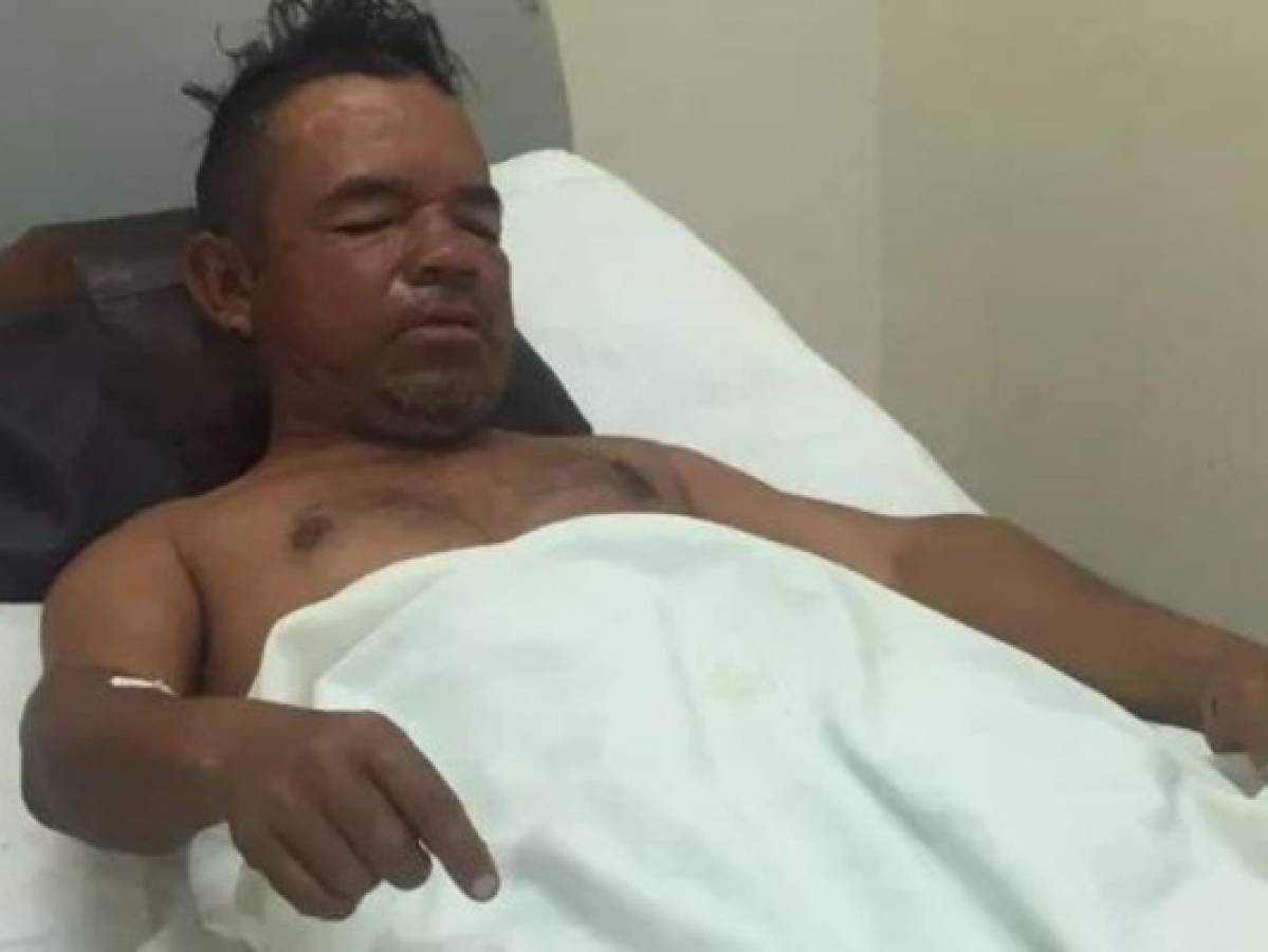Migrante hondureño mutilado por 'La Bestia': 'Apenas pude agarrarme y se me enredó el pie'