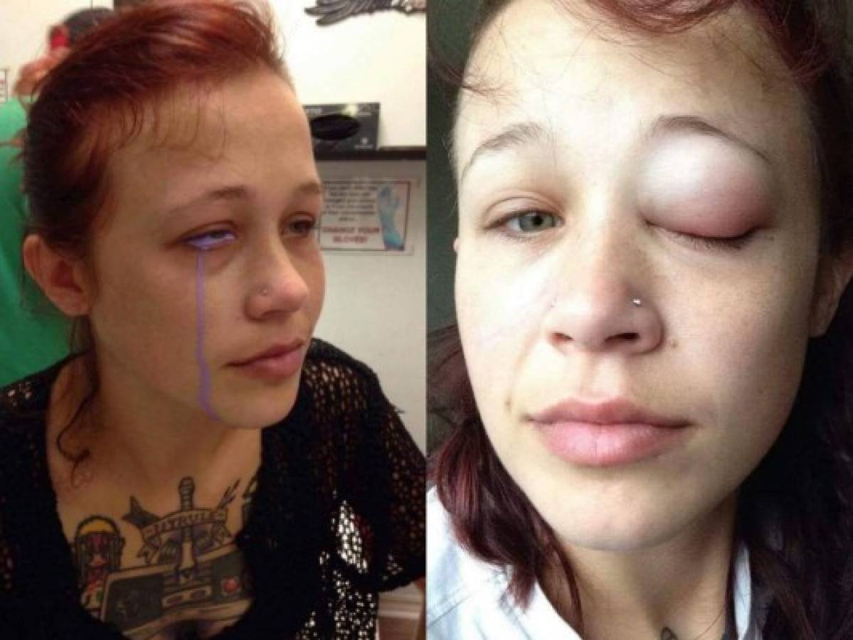 Quería verse diferente, se tatuó los ojos y sufrió las terribles consecuencias