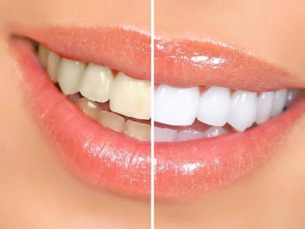 Cinco consejos caseros que debes tener en cuenta para blanquear tus dientes