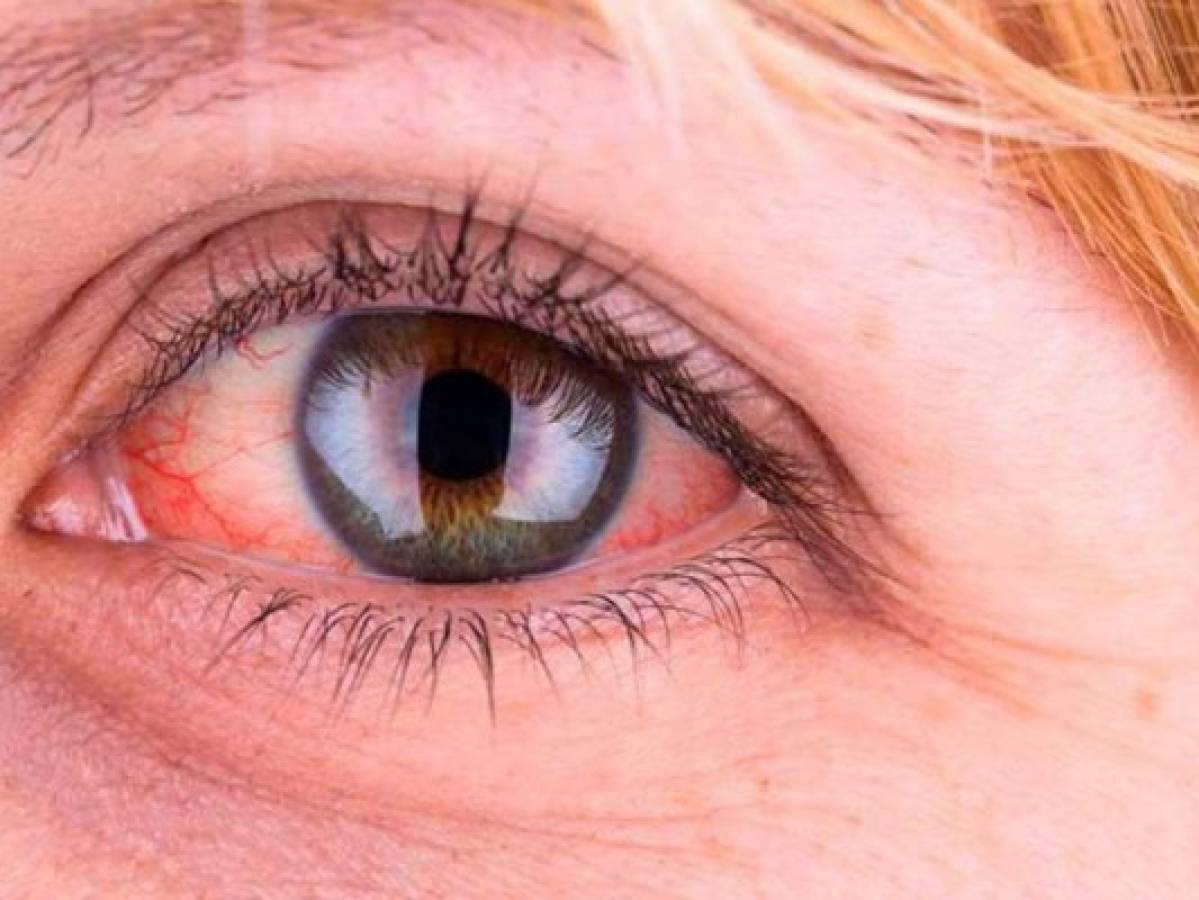 Ojos rojos, otro síntoma del Covid-19, según enfermera