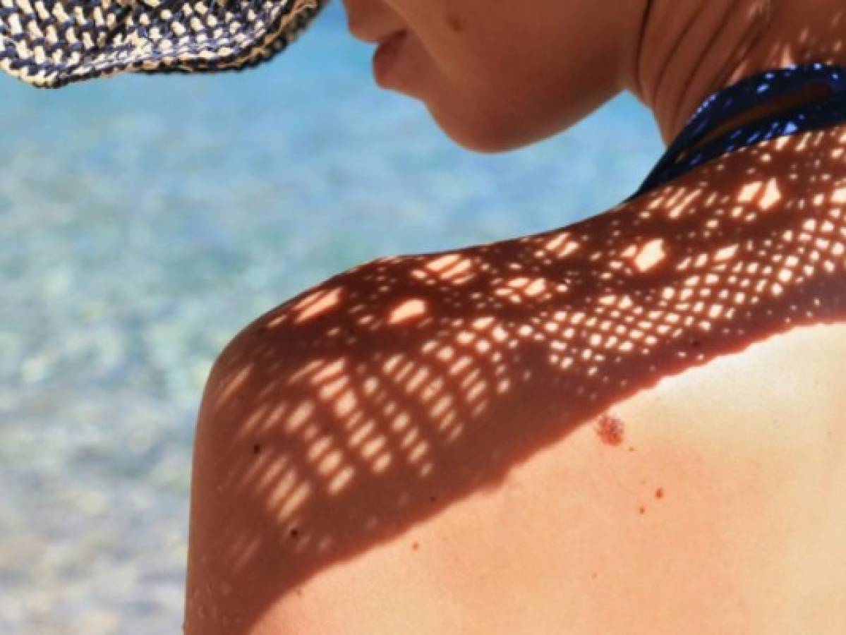 La sobreexposición al sol puede provocar cáncer de piel