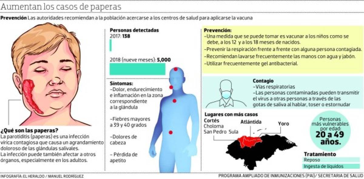 Secretaría de Salud emite alerta por un inusitado brote de paperas