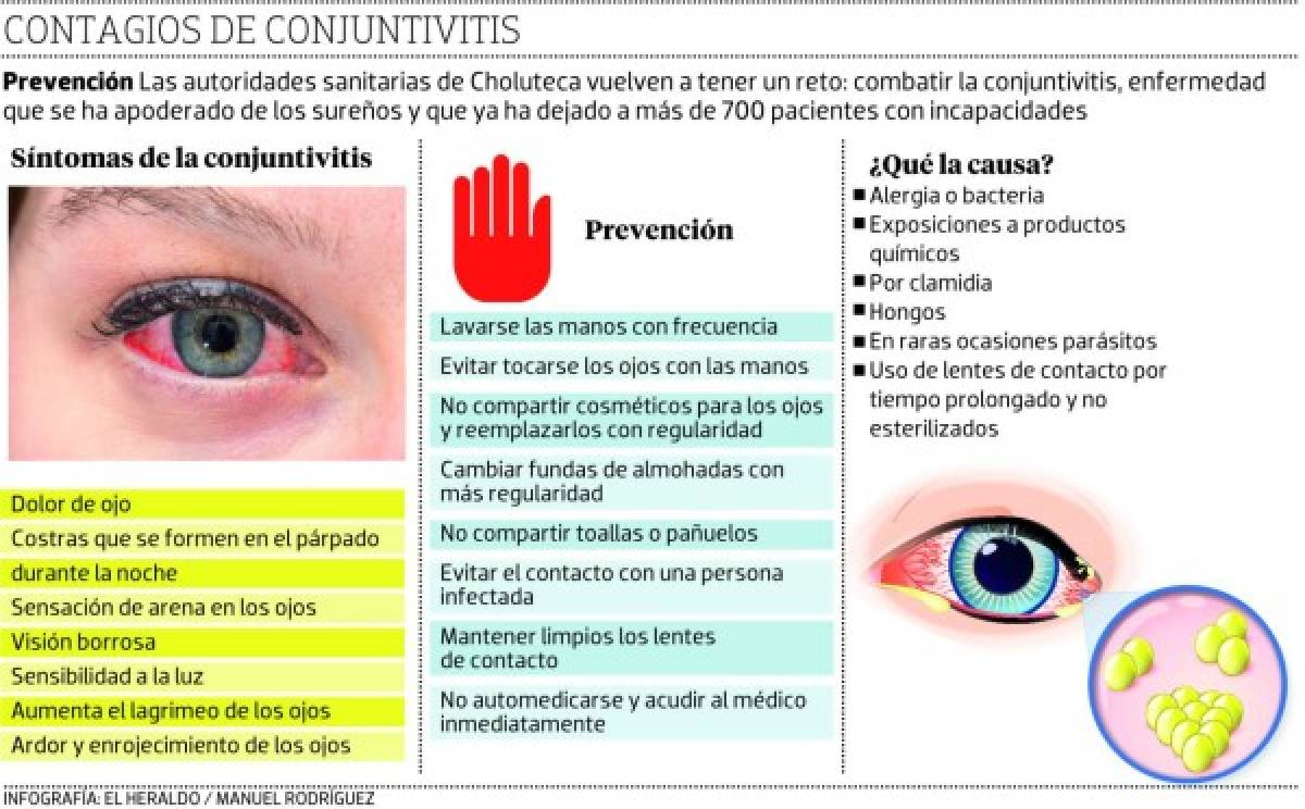 Bajo vigilancia Choluteca por brote de conjuntivitis