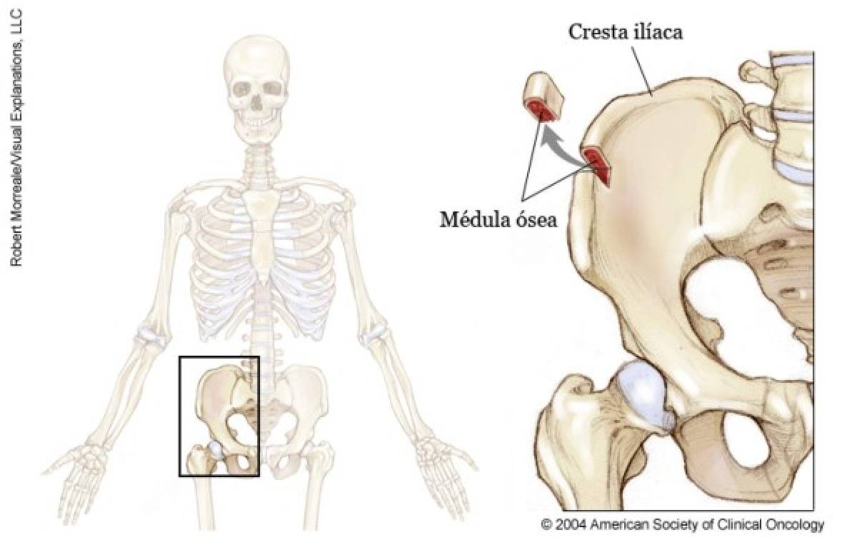 Así afecta a la médula ósea la leucemia AML, enfermedad que padece Rafael Callejas.