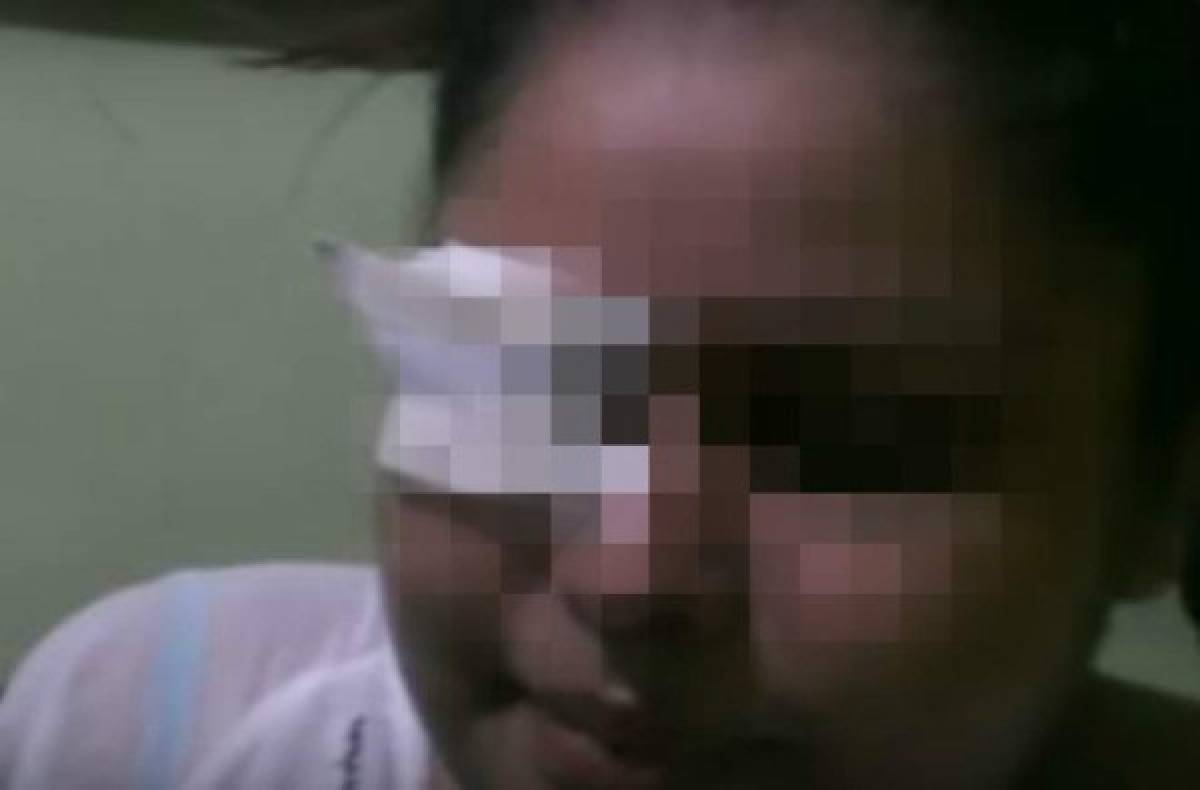 Hondureña relata horror que vivió tras perder ojo a manos de su pareja