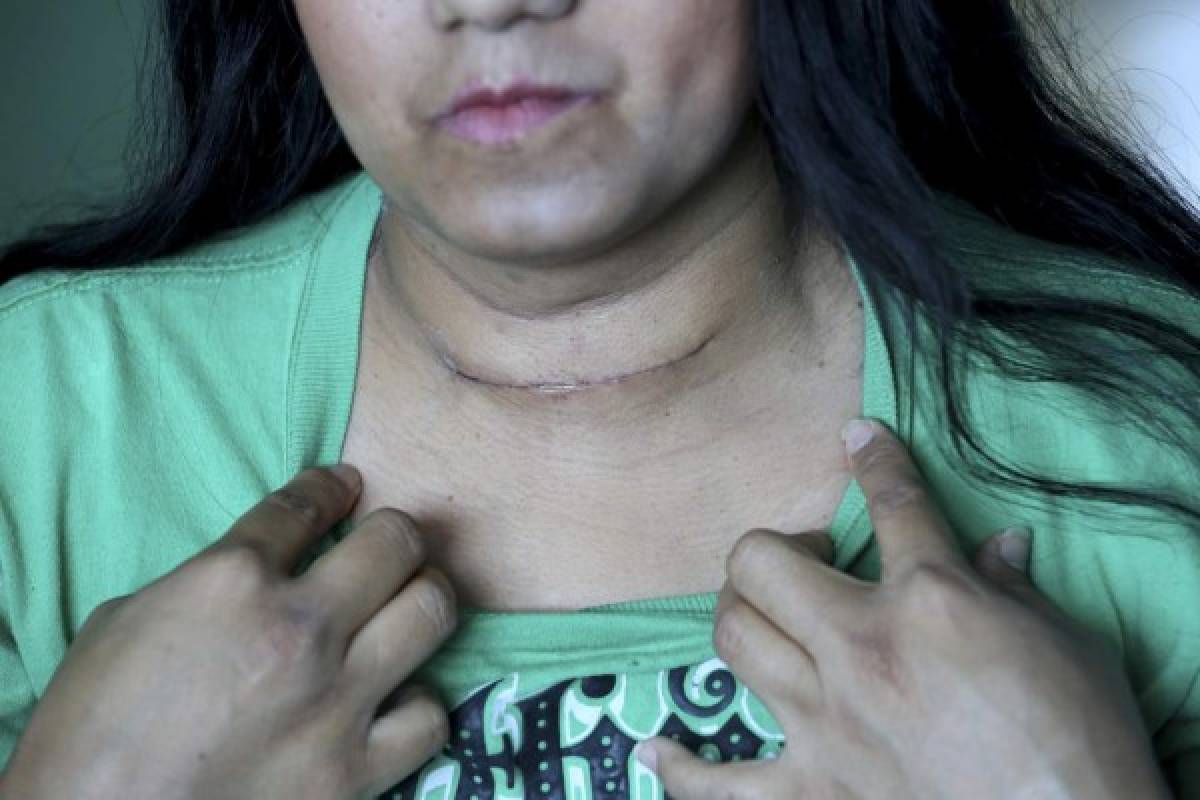 Honduras: cáncer de tiroides en la mujer desplaza al de cérvix