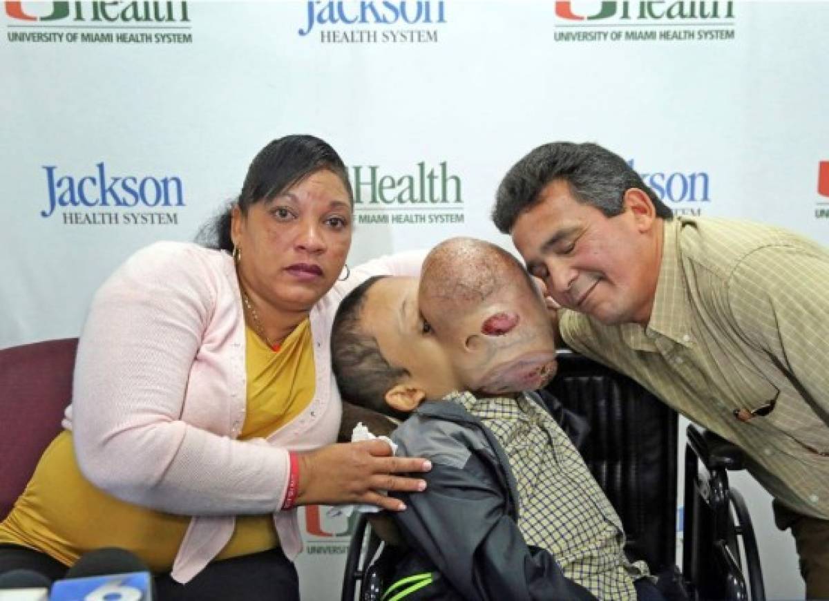Extirparán tumor de 4,5 kilos del rostro de niño en Miami