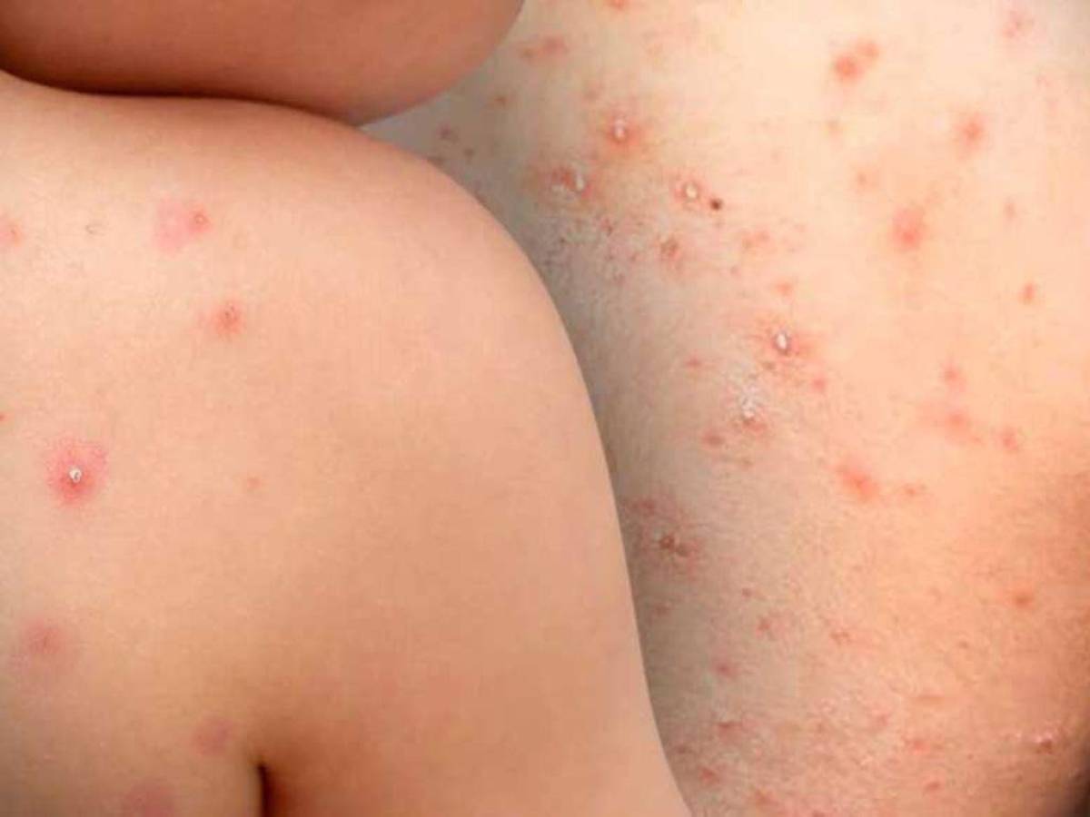 Diferencias entre los síntomas de la viruela del mono y la varicela