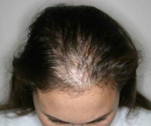 El especialista ha atendido a unas 20 mujeres y tres hombres con covid-19 con problemas de caída de cabello.