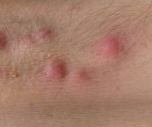 La hidradenitis son erupciones en la piel que afectan, en su mayoría, a las mujeres.