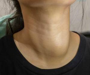 Esta glándula que está en el cuello justo arriba de la clavícula, es la responsable de producir las hormonas tiroideas (T3 Y T4) que regulan el crecimiento y desarrollo, el metabolismo, la temperatura corporal, la frecuencia cardíaca y la tensión arterial.