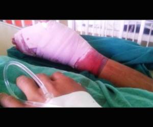 El menor fue intervenido quirúrgicamente luego de que la batería de un celular explotara en su mano. (Foto: cortesía Hospital Materno Infantil)