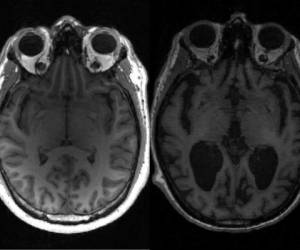 El grado de la enfermedad de Alzheimer se mide según la denominada 'Escala Braak'. Foto: AFP.