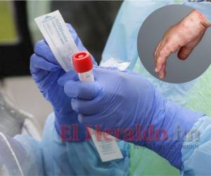 Las pruebas para confirmar los seis casos sospechosos de viruela símica se enviaron de SPS a Tegucigalpa. Se esperan los resultados para el lunes.