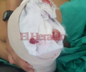 La víctima, residente en el barrio Guanacaste de Tegucigalpa, él lanzó una 'cebolla' y como vio que no explotó, regresó, la tomó, y al levantarla le estalló en la mano.