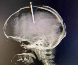 Esta fue la radiografía de Natanael García Polanco, de 33 años, quien dijo sentir el 'cerebro flojo'.