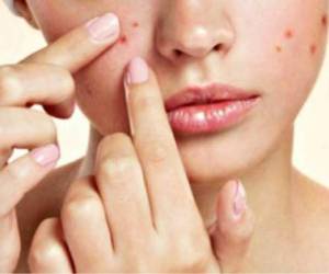 Si la persona tiene acné lo más recomendable es no tocarse la zona afectada. Foto: Agencia AFP