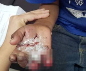 El menor sufrió graves quemaduras en su extremidad derecha por lo que tuvieron que amputarle la punta de dos dedos.