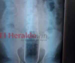 Esta radiografía muestra la botella en el interior del cuerpo del hondureño.