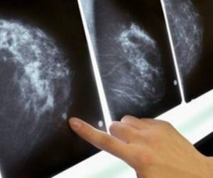 El cancer de mamas representa la segunda causa de cáncer en mujeres y al año hay 500 casos nuevos.