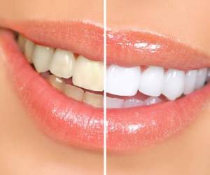 Afortunadamente, cuentas con varias opciones que puedes poner en práctica para conseguir dientes más blancos en menos de una hora.