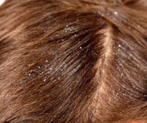 La caspa es un trastorno en el cuero cabelludo que provoca irritación y resequedad.