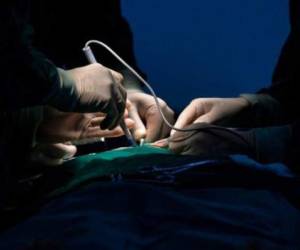 Se han reportado otros tres trasplantes de pene exitosos, dos en Sudáfrica y uno en el Hospital General de Massachusetts en 2016.