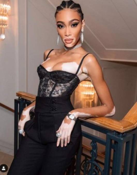 FOTOS: Winnie Harlow, la modelo que sería la nueva novia de Maluma